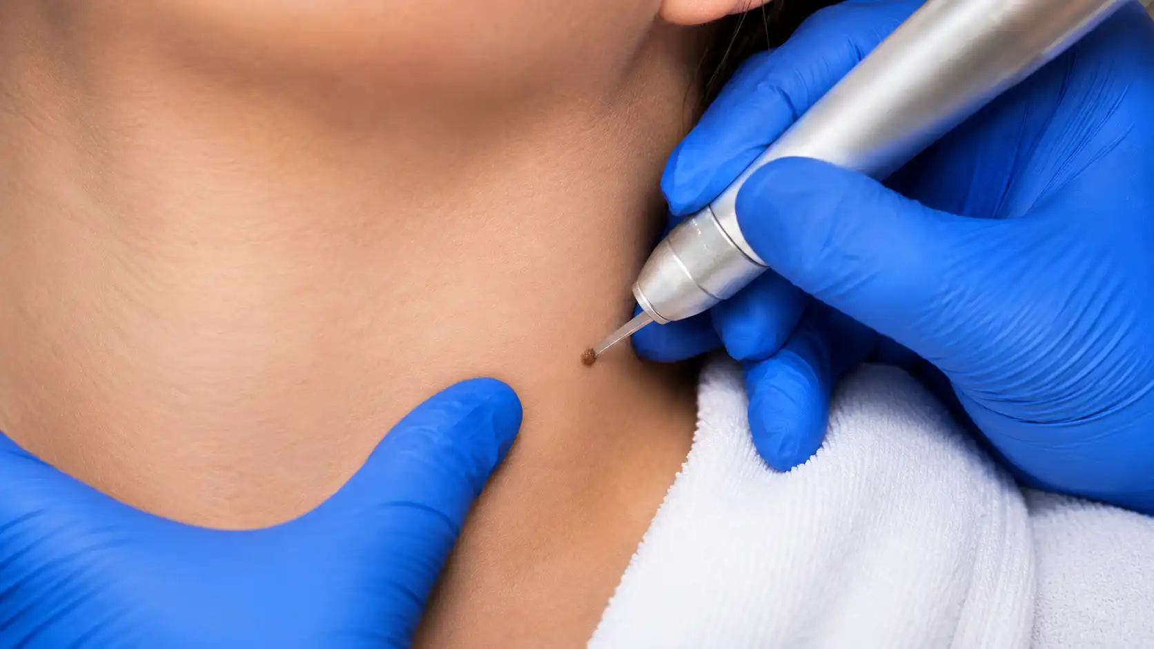 Acrocordones Eliminar sin Cicatrices, Así se Hace