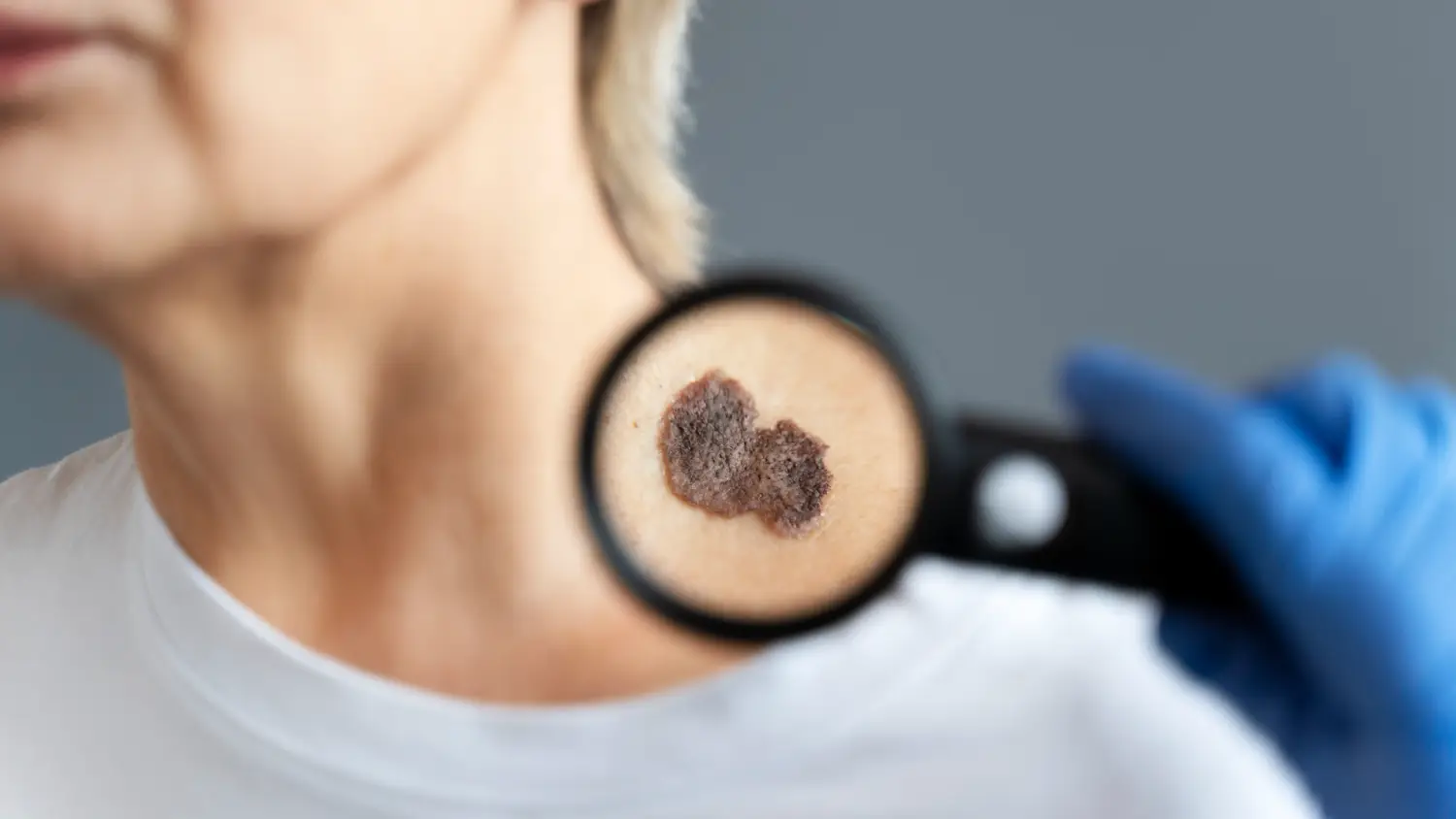 Queratosis Seborreica Tratamiento, Duración con Crioterapia